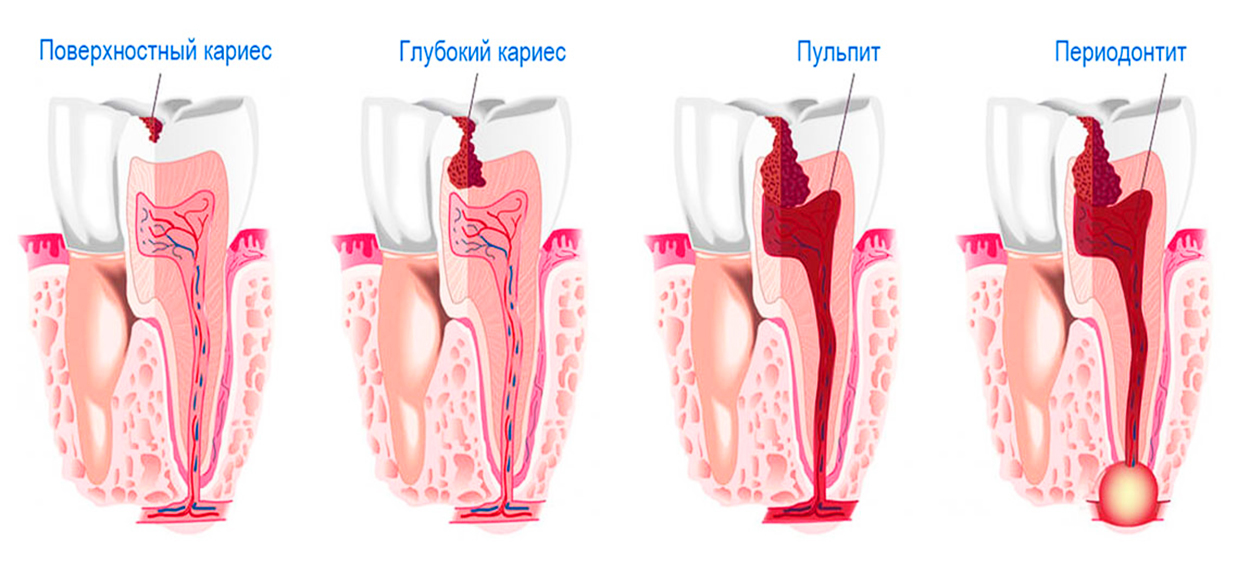 Осложнения периодонтита зуба. Многокорневой пульпит. Кариес пульпит периодонтит. Кариес эмали (поверхностный кариес) патанатомия. Этапы пульпита периодонтит.