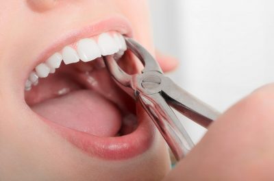 Dental-Extractions