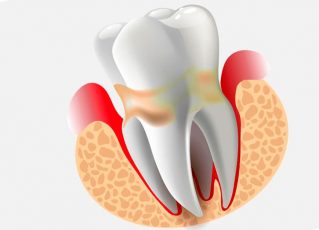 periodontit01